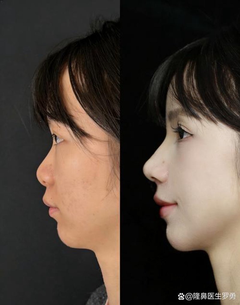 重塑美丽，从鼻梁的高度谈起